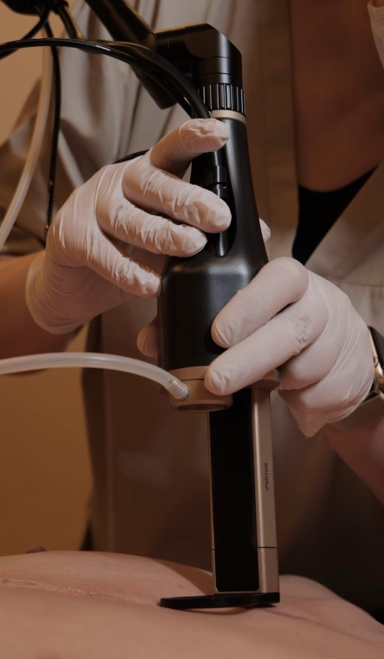 Aplicação clínica precisa do Laser CO2 Hybrid